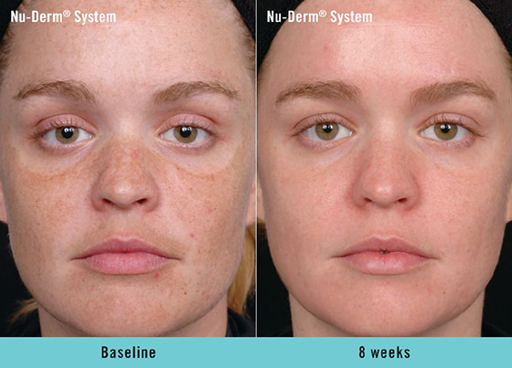 nuderm system before & after