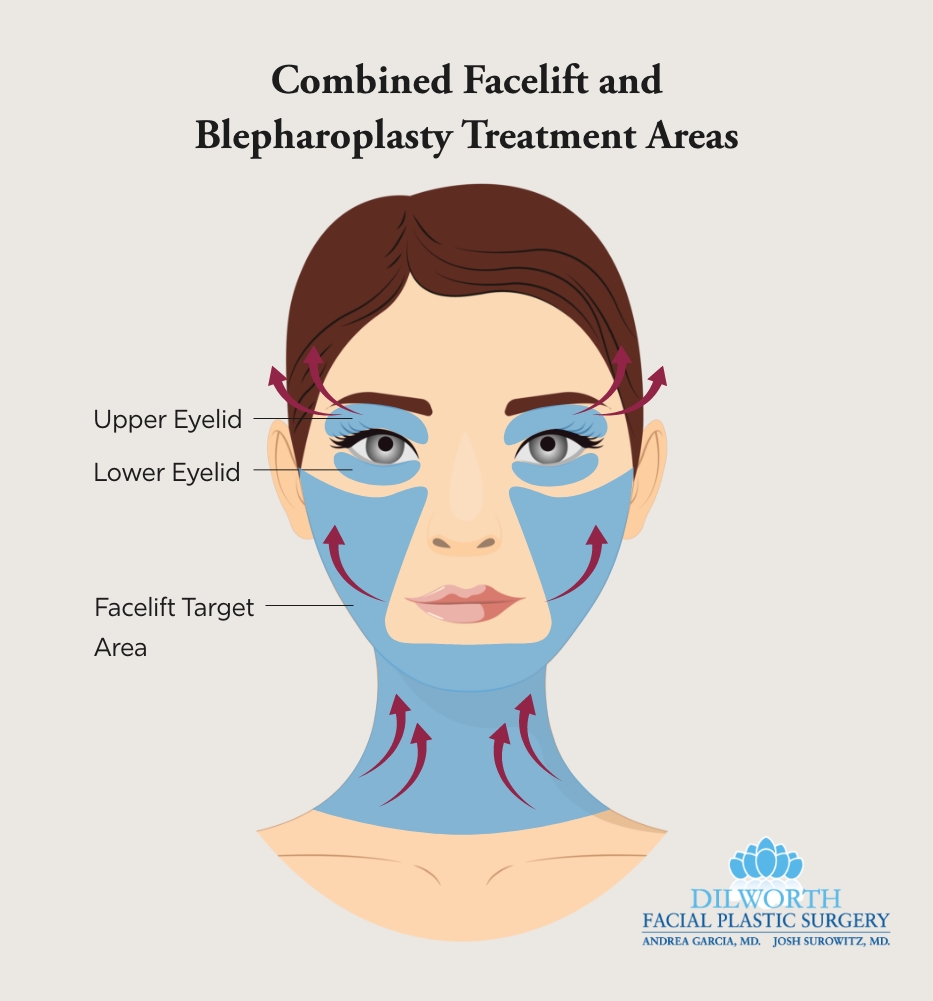 Combined Facelift and Blepharoplasty Treatment Areas Infographic