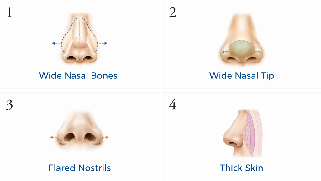 Diagram of factors contributing to wide nose, commonly addressed in rhinoplasty.