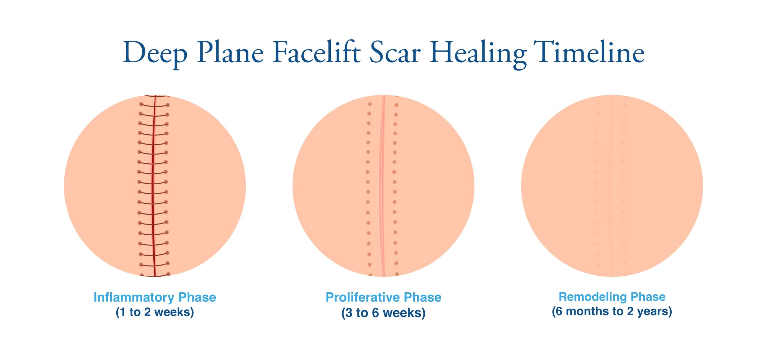 Infographic showing deep plane facelift scar healing phases: inflammatory at 1–2 weeks, proliferative at 3–6 weeks, and remodeling at 6 months–2 years.