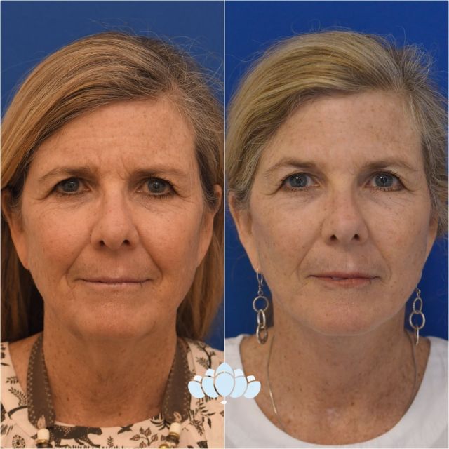 5 month postoperative facelift results of our lovely patient. No more jowling or sagging! This patient has a more improved jawline and neck, as well as smoother nasolabial folds and increased cheek volume.✨

Call us to schedule your consultation 
📞 980-949-6544

#facelift #facialplastics #beforeandafter #naturalresults #plasticsurgery #boardcertified #boardcertifiedfacialplasticsurgeons #dilworthfacialplastics #jowling #faceliftresults #faceliftbeforeandafter #facialplasticsurgeons