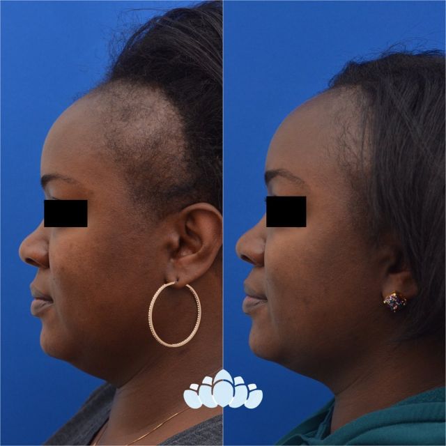 6 month postoperative hairline advancement results of our sweet patient. The hairline advancement procedure moves the hairline into a more natural, desired position.

Call us to schedule your consultation
📱 980-949-6544

#facialplastics #beforeandafter #naturalresults #plasticsurgery #boardcertified #boardcertifiedfacialplasticsurgeons #dilworthfacialplastics #facialplasticsurgeons #surgery #hairlineadvancement #hair