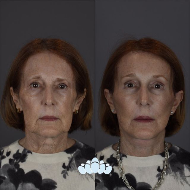 5 weeks postoperative deep plane facelift, upper & lower Blepharoplasty, and brow lift results. What a beautiful and natural transformation! ✨

Call to schedule your consultation
📱 980-948-6544

#facelift #facialplastics #beforeandafter #naturalresults #dilworthfacialplastics#jowling #faceliftresults #faceliftbeforeandafter #facialplasticsurgeons #boardcertifiedfacialplasticsurgeons #charlottenc #charlotte #northcarolina