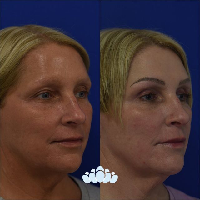 6 month postoperative upper blepharoplasty results. Her eyes now look more refreshed after having the excess skin and fat pad removed from her upper eyelids.✨

#facialplastics #beforeandafter #naturalresults #plasticsurgery #boardcertified #boardcertifiedfacialplasticsurgeons #dilworthfacialplastics #facialplasticsurgeons #surgery #upperblepharoplasty #upperblepharoplastybeforeandafter #upperbleph #uppereyelidlift