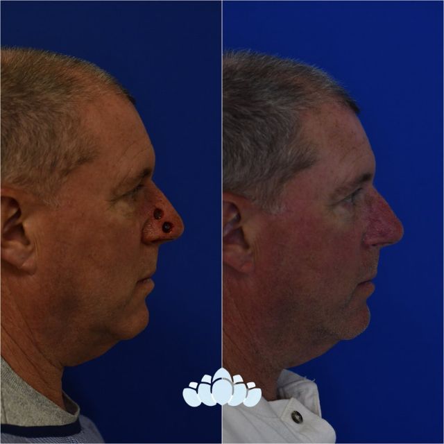 3 months postoperative MOHS (skin cancer) closure results. ✨ 

#facialplastics #beforeandafter #naturalresults #plasticsurgery #boardcertified #boardcertifiedfacialplasticsurgeons #dilworthfacialplastics #facialplasticsurgeons #surgery #mohs #skincancer