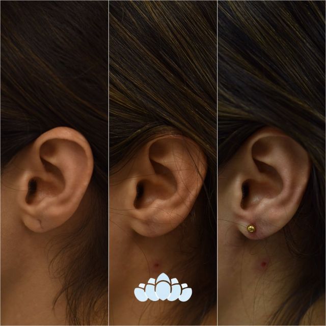 The stages of an earlobe repair. The first photo on the left shows an earlobe that has torn. The second photo is roughly 6 weeks after the earlobe repair procedure and the third photo is with ears pierced. We include piercing with our earlobe repair procedures.✨

#dilworthfacialplastics #earloberepair #tornearlobe #piercing