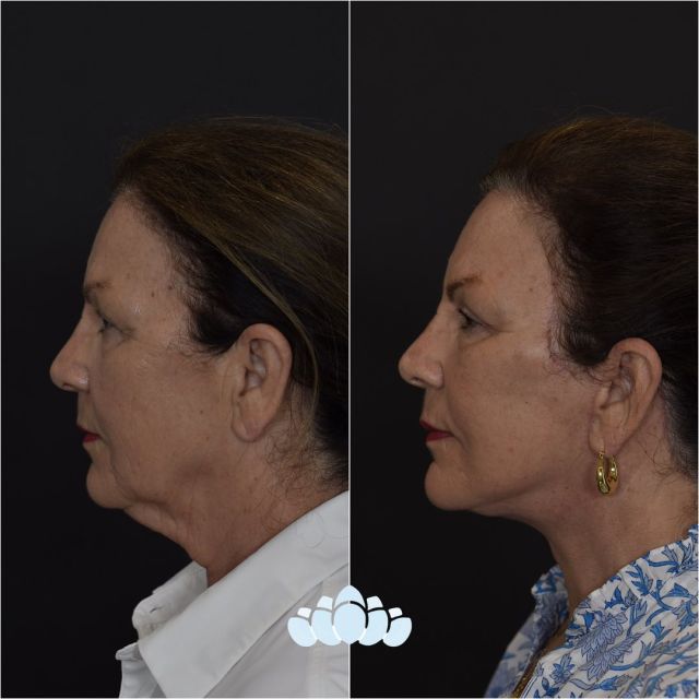Beautiful deep plane facelift results 9 weeks post operative.✨

#facelift #facialplastics #beforeandafter #naturalresults #dilworthfacialplastics #jowling #faceliftresults #faceliftbeforeandafter #deepplanefacelift #facialplasticsurgeons #boardcertifiedfacialplasticsurgeons #charlottenc #charlotte #northcarolina #drgarcia #drsurowitz