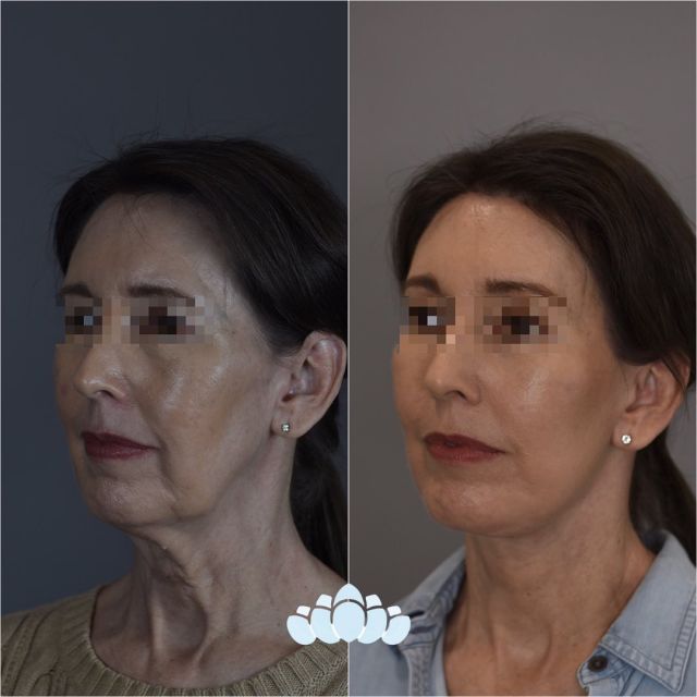 Stunning facelift, browlift, and upper and lower blepharoplasty results of our patient 7 months postoperative. Rejuvenation at its finest.✨

#facelift #facialplastics #beforeandafter #naturalresults #dilworthfacialplastics #jowling #faceliftresults #faceliftbeforeandafter #facialplasticsurgeons #boardcertifiedfacialplasticsurgeons #charlottenc #charlotte #northcarolina