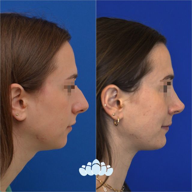 Beautiful rhinoplasty & chin implant results 13 months postoperative. The patient’s results were achieved by reducing the dorsal hump and projecting the tip of her nose.✨

#dilworthfacialplastics #rhinoplasty #rhinoplastybeforeandafter #nosejob #chinimplant #plasticsurgerybeforeandafter #charlotte #dilworth