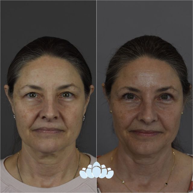 5 months postoperative upper blepharoplasty results of our patient. We love how natural her results are. ✨

#upperbleph #uppereyelidsurgery #dilworthfacialplastics #naturalresultsplasticsurgery