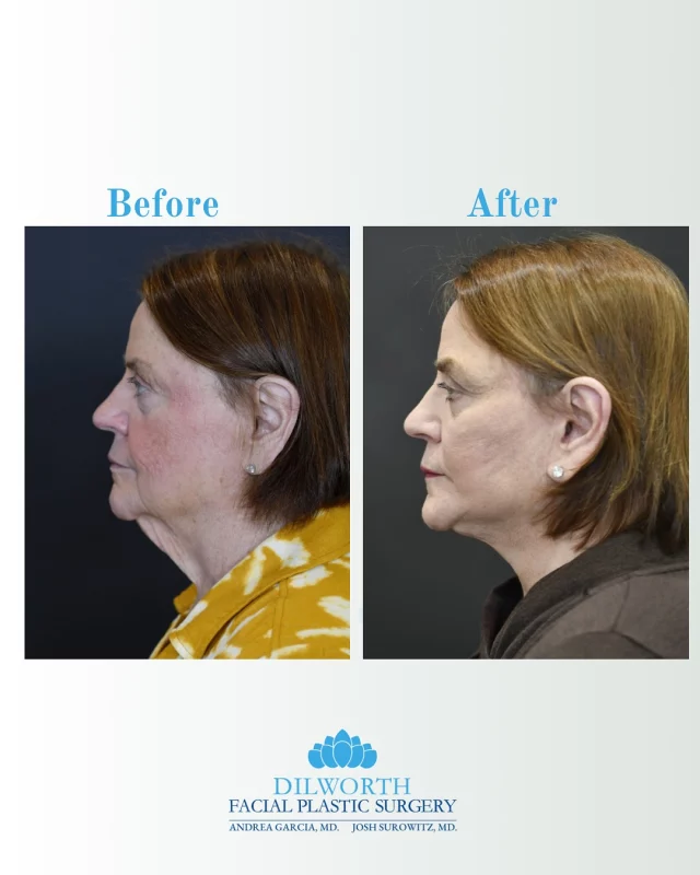 The power of precision.✨ This stunning transformation is the result of a face and neck lift combined with lower blepharoplasty. Our patient’s profile now reflects the vibrant, refreshed look she feels on the inside—lifting sagging skin, redefining the jawline, and brightening the under eyes. Ready for your own facial rejuvenation? Schedule a consultation with Dr. Garcia or Dr. Surowitz at Dilworth Facial Plastic Surgery today! 

#facelift #necklift #lowerblepharoplasty #eyebagremoval #facialrejuvenation #plasticsurgerybeforeandafter #naturalresults #charlotteplasticsurgery #dilworthfacialplastics #antiagingsolutions #refreshednotoverdone #confidenceboost #aginggracefully #facialplasticsurgery #beforeandaftertransformation #skintightening #underereye #facialcontouring #plasticsurgeryjourney #aestheticscharlotte