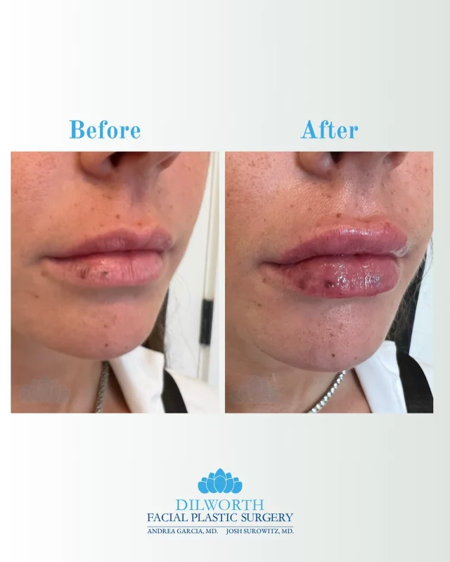 This gorgeous before & after was done by our very own Cassie, RN, using about 0.7mL of Kysse for the perfect natural plump. 💉✨ 

Your perfect pout is one message away 💋 DM or call to claim your spot! 
📞 980-949-6544

 #LipFiller #KysseFiller #NaturalLips #AestheticNurse #RNInjector #BeforeAndAfter #LipFillerCharlotte #KysseLips #SubtlePlump #FacialPlastics #CharlotteInjector #LipGoals