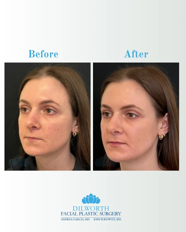 Small changes that can make a BIG difference ➡️

✨This beauty started with a chemical peel from Allie, then added chin and lip filler with Morgan for that perfectly balanced finish. ✨

Book an appointment by DM or call to book your spot!
📞 980-949-6544

chemical peel results, lip filler before and after, chin filler transformation, facial balancing, natural filler results, skin rejuvenation, subtle enhancements, facial contouring, Charlotte facial plastic surgery, glow up inspiration, aesthetic treatments, non-surgical beauty, confidence boost, radiant skin

#ChemicalPeel #LipFiller #ChinFiller #FacialBalancing #BeforeAndAfter #SkinRejuvenation #NaturalResults #GlowUp #AestheticTreatments #FacialContouring #CharlotteNC #CharlotteAesthetics #CharlotteFacialPlasticSurgery #NonSurgical #SubtleEnhancements #RadiantSkin #ConfidenceBoost #BeautyJourney #SelfCare #SkinGoals