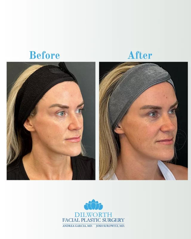 ✨ Sculptra Results ✨
Sculptra stimulates your body’s own collagen production to restore facial volume and achieve natural, gradual rejuvenation. Results continue to improve over time — just like this gorgeous transformation! 💉✨

Call or dm to book your spot! 

#sculptra #sculptraresults #sculptrabeforeandafter #facialrejuvenation #collagenboost #naturalresults #nonsurgicalfacelift #antiagingtreatment #glowupjourney #snatchedskin #youthfulglow #aginginreverse #injectablescharlotte #charlottemedspa #dilworthfacialplasticsurgery #skincaregoals #facecardneverdeclines #beautyboost #contourqueen #viralglowup #subtleenhancements #skintightening #glowgetter