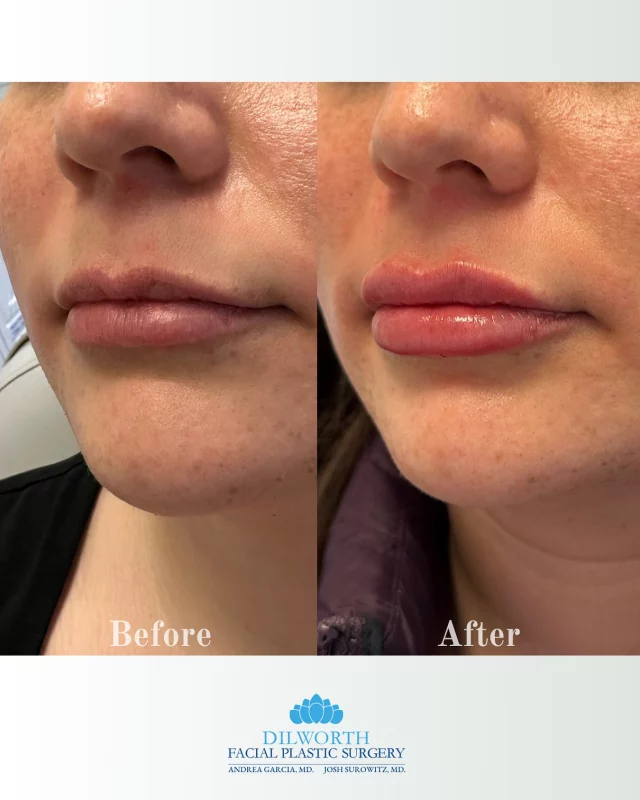 Warning: Side effects may include staring at yourself in every mirror. Book your lip filler appointment with us today 💋

#lipfiller #beforeandafter #lipinjections #aesthetics #injectables #beautyboost #naturalresults #charlotteaesthetics #confidenceboost #fillerresults #plumplips #nonsurgical #glowupseason #lipgoals #selfcare