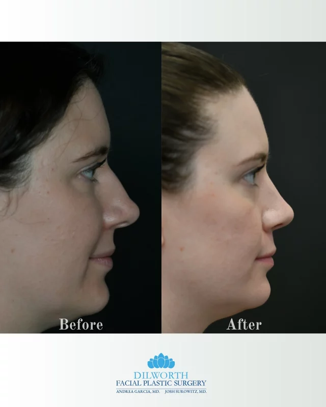 👃 Thinking about a nose job but worried it’ll look “too done”?
Here’s proof that rhinoplasty can be subtle, refined, and completely tailored to your face. This before and after shows just how impactful small adjustments can be. From smoothing bumps to perfecting proportions, this transformation is all about natural results and long-term confidence! 

Dm or call us to book a consultation! 🫶🏼✨

rhinoplasty before and after, nose job before and after, rhinoplasty results, nose transformation, cosmetic surgery results, facial plastic surgery, natural rhinoplasty, subtle nose job, side profile transformation, nose contouring, Charlotte facial plastic surgeon, best rhinoplasty Charlotte, rhinoplasty specialist, nose reshaping surgery, aesthetic nose surgery, nose job recovery, surgical transformation, confidence after rhinoplasty, facial symmetry surgery, real rhinoplasty patient