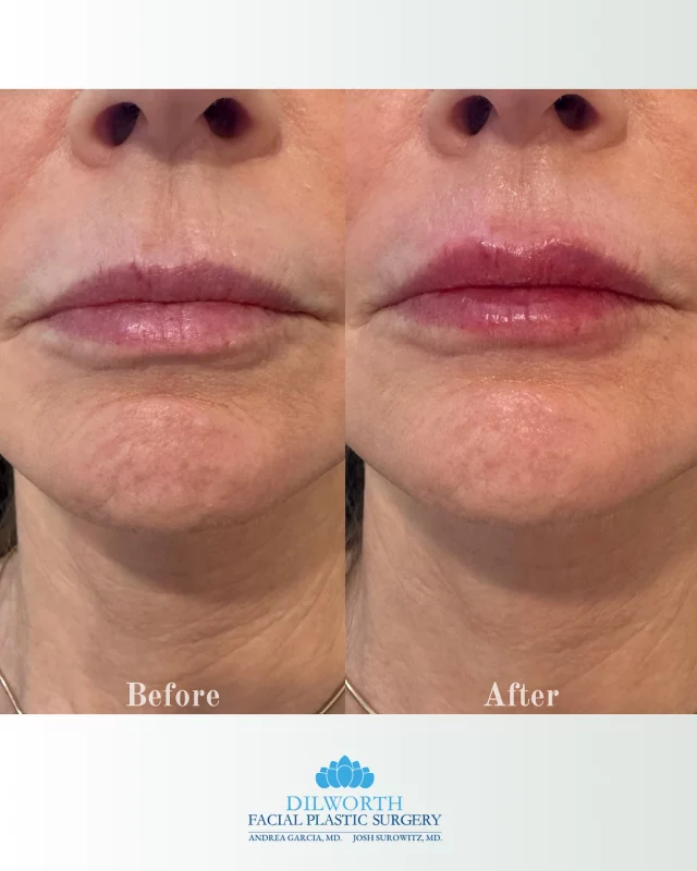 This beauty came in wanting a little extra volume in her top lip and added hydration in the bottom — subtle, balanced, and beautifully done by our injector Morgan. 💋✨

DM or call us to book your appt! 
📱(980) 949-6544

Lip filler before and after, natural lip enhancement, top lip volume, hydrated lips, subtle lip filler, Charlotte lip filler, lip filler expert, Morgan the injector, lip injections Charlotte NC, lip filler transformation, non-surgical lip augmentation, balanced lips, lip filler for volume, lip filler for hydration, cosmetic injectables, aesthetic nurse injector, natural-looking results, lip filler goals, enhance your pout, dermal filler Charlotte, lip filler specialist, lip filler appointment, beauty treatments Charlotte