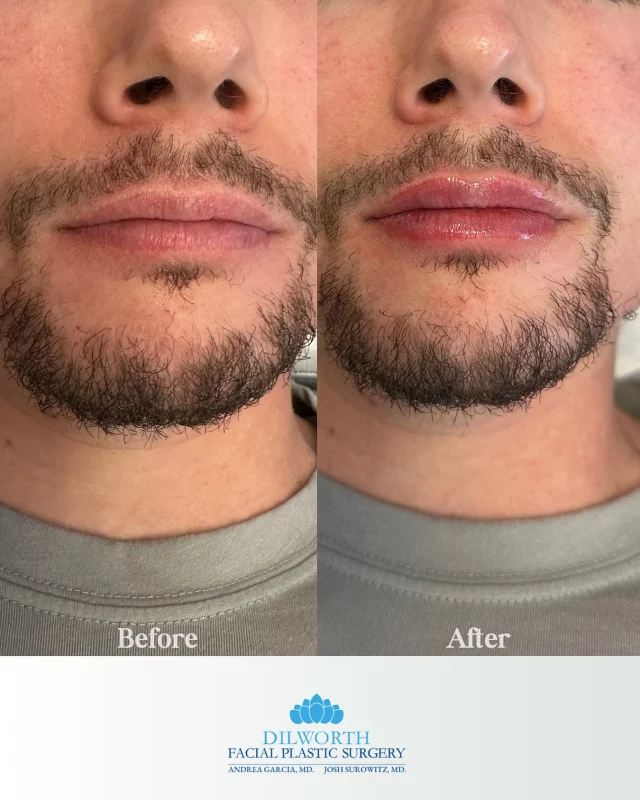 Who said lip filler’s just for the girls? Guys deserve that glow-up too, just look at these results 👄🔥

Call or DM us to book your spot! 

lip filler before and after, men with lip filler, male aesthetics, guys get filler too, filler transformation, non-surgical enhancements, confidence boost, cosmetic injections for men, natural lip filler results, subtle lip filler, beauty is for everyone, self care for men, lip filler results, injectables before and after, men’s grooming, filler glow up, modern masculinity, normalize filler, aesthetic medicine, cosmetic treatment, Charlotte lip filler