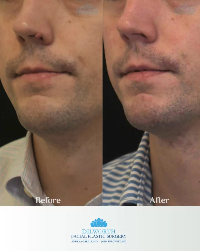 A simple change can make a big difference. This patient’s mole removal left his nose smoother and more balanced — and he’s loving the results! 

Call or DM to schedule your next mole removal with our Nurse Practitioner Morgan! 

before and after mole removal, nose mole removal results, nose mole removal before and after, Charlotte mole removal, Dilworth Facial Plastics mole removal, cosmetic mole removal Charlotte NC, facial mole removal transformation, nose mole removal Charlotte, before and after cosmetic procedure, expert mole removal Charlotte, natural looking mole removal, nose mole removal surgery results, facial plastic surgery Charlotte NC, Charlotte plastic surgeons, nose mole removal success story, clear skin after mole removal, Charlotte facial plastics, mole removal healing process, professional mole removal Charlotte, Dilworth mole removal specialists