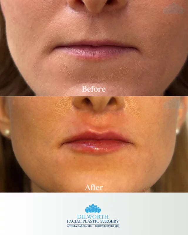 💋 Subtle, natural, refreshed. Our lip filler treatments are all about enhancing your features never overdone.
Ready for your own transformation? Call or DM us today to book your consultation!

Lip filler before and after, Charlotte lip filler, natural lip enhancement, subtle lip filler results, lip augmentation Charlotte NC, best lip filler clinic in Charlotte, Dilworth Facial Plastics lip filler, natural looking lip injections, fuller lips before and after, lip filler transformations, lip filler swelling stages, Juvederm lip filler Charlotte, lip filler done right, enhance your natural beauty, lip filler specialist Charlotte, natural pout enhancement, cosmetic injectables Charlotte, Botox and filler clinic Charlotte, lip filler with Morgan NP, safe lip filler Charlotte
