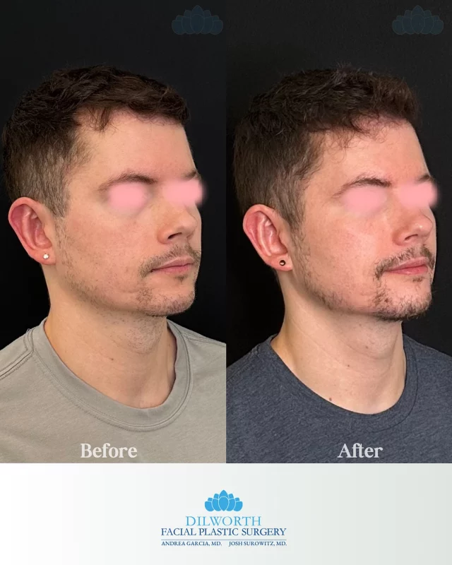 Before ➡️ After ✨ These results come from the collagen-stimulating power of Sculptra combined with PDGF for skin rejuvenation. The glow is real, and it just keeps getting better with time! 

Sculptra, PDGF treatment, collagen stimulation, skin rejuvenation, facial volume restoration, natural looking results, anti-aging treatments, non-surgical facelift, aesthetic medicine, skin tightening, smoother skin texture, long-lasting results, youthful glow, wrinkle reduction, skin health, Charlotte medspa, Dilworth Facial Plastics, facial contouring, regenerative treatments, aesthetic injector, natural beauty enhancement, collagen production, non-invasive treatments, before and after results, cosmetic injectables, Charlotte aesthetics, radiant skin, skin rejuvenation clinic, medical grade treatments