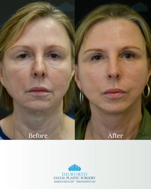 ✨ Transformation you can see ✨ This beautiful result is just 9 weeks post-op after a face & neck lift combined with perioral CO2 laser. Notice the smoother jawline, refreshed skin, and natural rejuvenation. Confidence restored 💙 

Book a consult with us! 

Face lift results Charlotte, neck lift transformation, perioral CO2 laser before and after, Charlotte plastic surgery, natural facial rejuvenation, anti-aging treatments Charlotte NC, smoother jawline results, facelift and neck lift recovery, CO2 laser resurfacing, best facial plastic surgeon Charlotte, Dilworth Facial Plastic Surgery, youthful skin transformation, 9 weeks post-op facelift, confidence boosting results, non-surgical skin rejuvenation options, Charlotte cosmetic surgery experts.