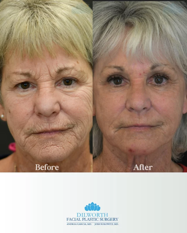✨ 6 months later… what a transformation! Full face CO2 + perioral dermabrasion = smoother, brighter, younger-looking skin.

Call or DM us to book your consult today! 

Full face CO2 laser results, perioral dermabrasion before and after, 6 month skin transformation, smoother skin texture, reduce fine lines and wrinkles, skin resurfacing results, Charlotte facial plastics, Dilworth Facial Plastics, advanced skin rejuvenation, laser resurfacing before and after, collagen boosting treatments, post CO2 healing process, scar reduction treatments, brighter glowing skin, facial rejuvenation Charlotte NC, med spa before and after, anti-aging skin treatments, skin renewal results, cosmetic laser treatment Charlotte, dermatologist approved skincare results.