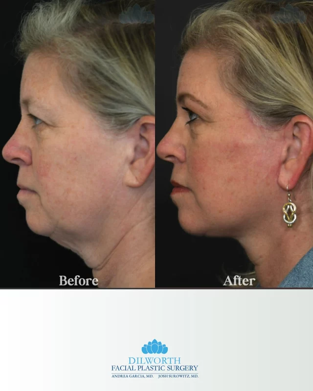 Just 3 months post-op and already looking incredible! ✨ This face and neck lift restored definition, tightened skin, and created a naturally refreshed look, no filters needed. Results will continue to refine over the next few months! 

face and neck lift, facelift Charlotte NC, neck lift Charlotte NC, facial rejuvenation surgery, lower face lift, jawline contouring, tighten loose skin, reduce jowls, natural facelift results, surgical facial rejuvenation, mini facelift Charlotte, best facial plastic surgeon Charlotte, anti-aging surgery, before and after facelift, facelift recovery, 3 month facelift results, neck tightening, youthful appearance, facial contour restoration, smooth neck and jawline, Dilworth Facial Plastics, Charlotte cosmetic surgery, long-lasting facelift results, subtle natural enhancement, confident refreshed look