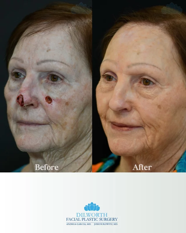 ✨ 8 months post-op following MOHS reconstruction.
Our goal with every reconstruction is to restore both function and a natural aesthetic result. This patient’s healing journey is a beautiful reminder of how time, technique, and aftercare work together.

facial reconstruction Charlotte, MOHS reconstruction before and after, skin cancer reconstruction, facial plastic surgeon Charlotte NC, reconstructive surgery results, natural healing after MOHS, post-MOHS scar repair, skin cancer removal recovery, reconstructive facial plastic surgery, Dilworth Facial Plastics Charlotte