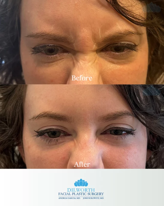Boo to 11s, yay to smooth ✨ Spooky season = over. Botox season = forever. Ready when you are! Call or DM to book and HAPPY HALLOWEEN! 🎃 

Botox, Botox near me, Charlotte Botox, facial aesthetics, wrinkle treatment, forehead lines, 11 lines, frown lines, anti-aging treatment, smooth skin, youthful glow, aesthetic injector, cosmetic clinic Charlotte, Botox before and after, natural Botox results, before and after Botox