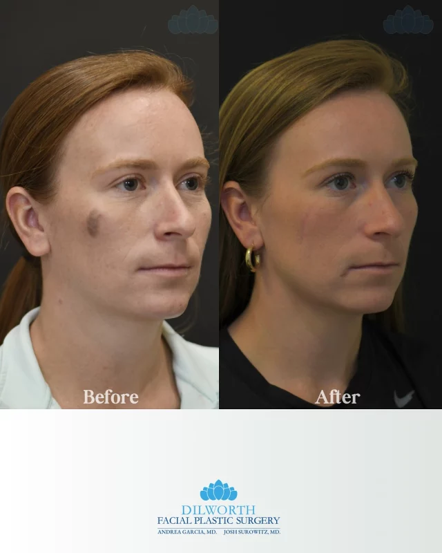 Birthmark removal in Charlotte, NC ✨
This patient is 7 months post birthmark excision, and the results speak for themselves, smooth, minimal scarring, and restored confidence 💉

birthmark removal, birthmark excision, mole removal, scar revision, skin lesion removal, aesthetic procedure Charlotte, Charlotte facial plastics, Charlotte aesthetics, smooth skin results, scar healing journey, confidence in your skin, post op healing, before and after results, minimal scar treatment, cosmetic skin procedure, skin confidence boost, aesthetic skin care, facial procedure results, skin transformation, Charlotte skincare experts