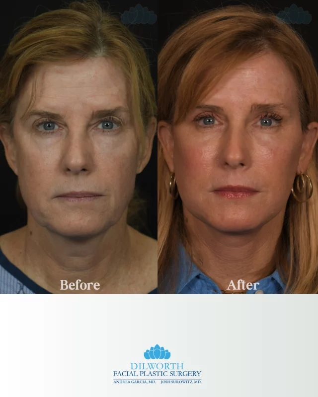 ✨ 6 weeks post-op transformation ✨
This beautiful patient underwent a facelift, brow lift, quad bleph, and fat transfer and she’s healing beautifully. Still early in the recovery journey, but the results are already speaking for themselves. 💙

facelift before and after, brow lift results, quad blepharoplasty before and after, fat transfer face results, full face rejuvenation, 6 weeks post op facelift, facial plastic surgery charlotte, natural facelift results, lower face lift results, upper bleph results, eyelid surgery before and after, mini facelift charlotte nc, aesthetic surgery transformation, facial contouring results, plastic surgery recovery stages, charlotte medspa, charlotte facial plastics, facial rejuvenation procedures, best facelift surgeon charlotte, brow lift transformation, eyelid lift charlotte, fat grafting face before after, cosmetic surgery results, youthful face restoration, facelift patient journey, aesthetic before and after