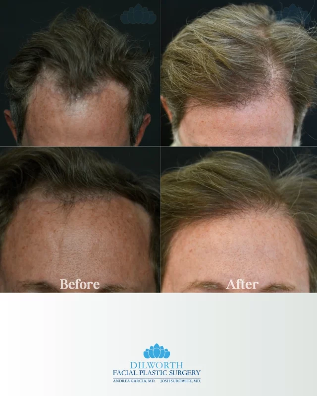 This is what 9 months of consistent growth looks like after a hair transplant at Dilworth Facial Plastics.
✔️ Natural hairline design
✔️ Gradual density
✔️ Permanent results
If thinning or shedding has been on your mind, let’s talk options.

hair restoration, Charlotte hair transplant, Dilworth Facial Plastics, 9 month hair transplant results, natural hairline restoration, male hair loss treatment, female hair loss treatment, PRP for hair growth, hair density improvement, before and after hair transplant, hair regrowth journey, Charlotte cosmetic surgery, restore thinning hair, hair transplant specialist, hair rejuvenation, North Carolina hair restoration, confidence boost, permanent hair results, hair transplant clinic Charlotte, hair growth transformation