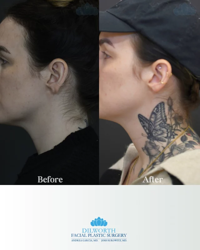 If your earrings aren’t sitting right anymore, ear lobe repair may be the solution. ✨ This treatment restores support and includes complimentary re-piercing once healed at 6 weeks!
Call or DM to book a consult! 

💙💙💙💙💙💙💙💙💙💙💙💙💙💙💙
Ear lobe repair, ear lobe rejuvenation, aging ear lobes, stretched ear lobes, torn ear lobe repair, ear lobe volume loss, ear lobe creasing, ear lobe treatment, cosmetic ear lobe repair, non surgical ear lobe repair, ear lobe restoration, ear lobe rejuvenation before and after, ear lobe repair results, earring support repair, ear lobe repair for heavy earrings, ear lobe repair with re piercing, complimentary ear re piercing, aesthetic ear treatments, facial aesthetics clinic, medical aesthetics, cosmetic injectables clinic, Charlotte med spa, Charlotte aesthetics, North Carolina med spa