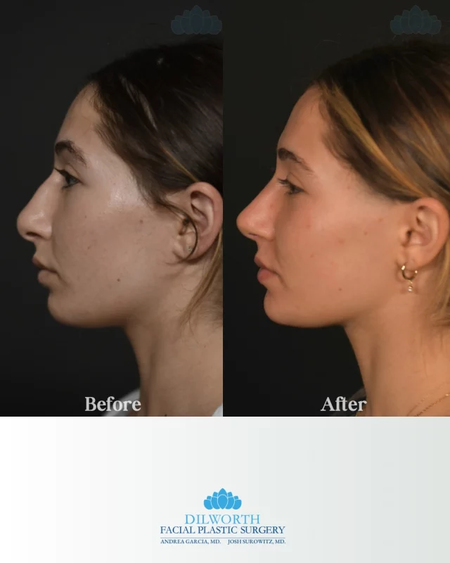6 months post-rhinoplasty ✨ Subtle refinement, balanced proportions, and results designed to look natural—just enhanced.

🩵🩵🩵🩵🩵🩵🩵🩵🩵🩵🩵🩵🩵🩵🩵

rhinoplasty before and after, 6 months post rhinoplasty, female rhinoplasty results, natural rhinoplasty results, nose job before and after, rhinoplasty healing timeline, facial balance rhinoplasty, subtle nose refinement, plastic surgery before and after, cosmetic nose surgery, natural looking nose job, board certified facial plastic surgeon, Charlotte plastic surgery, Charlotte rhinoplasty, North Carolina facial plastic surgeon, profile refinement surgery, aesthetic nose surgery, real patient results, facial harmony plastic surgery, rhinoplasty transformation