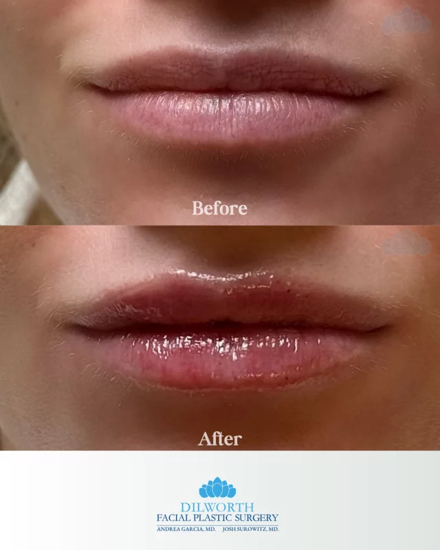 Starting the year with a little extra confidence 💋
Lip filler can restore volume, enhance shape, and smooth fine lines while still looking like you. 💉 Give us a call to book your lip filler appointment today! 

lip filler before and after, natural lip filler results, lip filler Charlotte NC, lip injections Charlotte, subtle lip enhancement, hyaluronic acid lip filler, natural looking lip injections, lip filler results 2026, cosmetic injectables Charlotte NC, facial plastic surgeon lip filler, non surgical lip enhancement, hydrated lips filler, lip volume enhancement, lip filler near me, aesthetic injectables Charlotte, Dilworth Facial Plastic Surgery lip filler