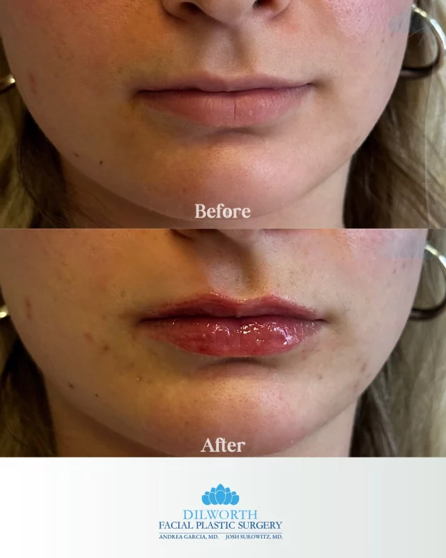Natural, hydrated, and perfectly balanced ✨💋
This before & after shows how lip filler can enhance shape, add subtle volume, and restore hydration without looking overdone. Our goal is always lips that look like you, just refreshed.

Performed by our expert facial plastic surgeons, every treatment is customized to your facial anatomy for soft, natural-looking results you’ll love.

💉 Lip filler in Charlotte, NC
📍 Dilworth Facial Plastic Surgery

Ready to enhance your lips?
DM or call our office to schedule your lip filler consultation today.

lip filler Charlotte NC, natural lip filler results, lip filler before and after, subtle lip enhancement, facial plastic surgeon Charlotte, hyaluronic acid lip filler, lip injections Charlotte, natural looking lip filler, lip filler consultation Charlotte, Dilworth Facial Plastic Surgery, refreshed lips not overfilled, lip filler results Charlotte, aesthetic injector Charlotte NC, lip filler for hydration, custom lip filler treatment