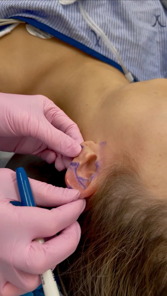 Prominent ears? There is a solution 👂✨
A bilateral otoplasty reshapes and repositions both ears for a more balanced, natural look and the results are long-lasting.
Our doctors focus on subtle changes that make a big confidence difference 💙
📍 Curious if you’re a candidate? Book a consultation with our team today.

bilateral otoplasty, ear pinning surgery, otoplasty before and after, prominent ears correction, ear reshaping surgery, facial plastic surgery, cosmetic ear surgery, natural looking otoplasty, ear surgery results, facial balance procedure, confidence boosting surgery, plastic surgeon in Charlotte, Charlotte facial plastic surgery, cosmetic surgery education, board certified facial plastic surgeon, ear surgery for adults, subtle cosmetic results, facial aesthetics