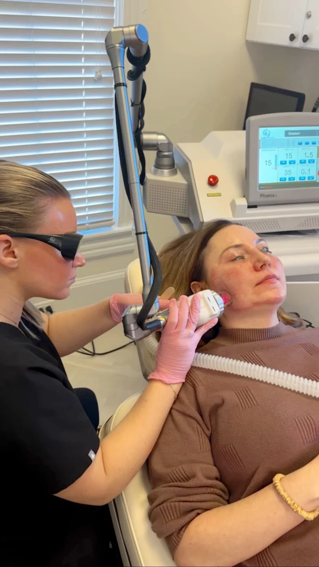 Is CO₂ laser worth it? If you’re looking to improve skin texture, soften fine lines, reduce acne scars, and boost collagen from the inside out — the answer might be yes ✨

CO₂ laser is one of the most powerful skin resurfacing treatments for long-term results, not quick fixes. With the right provider and a personalized treatment plan, it can deliver smoother, firmer, more even-toned skin over time.

Thinking about CO₂ laser but not sure if it’s right for you? Our experts at Dilworth Facial Plastics will walk you through expectations, downtime, and results so you can make an informed decision.

👉 Book a consultation today to see if CO₂ laser is worth it for you. 

CO2 laser treatment, CO2 laser resurfacing, is CO2 laser worth it, laser skin resurfacing Charlotte NC, acne scar laser treatment, anti aging laser treatment, collagen stimulating treatments, skin texture improvement, fine line and wrinkle treatment, Dilworth Facial Plastics