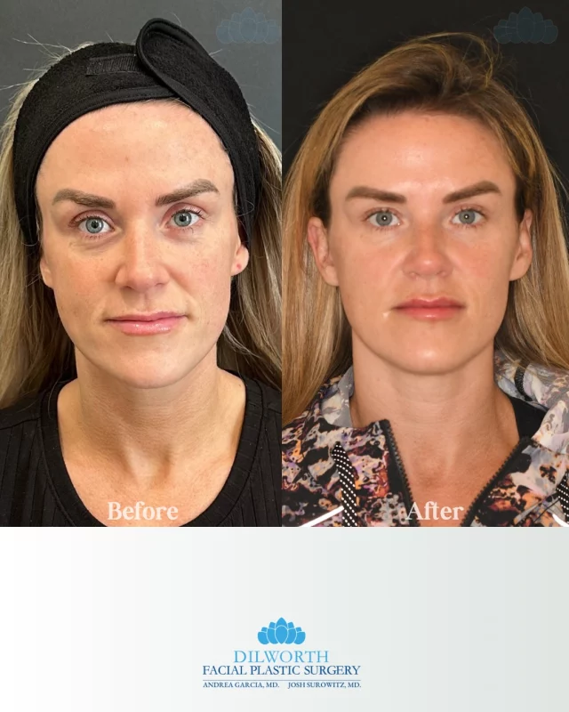 Almost a year in the making ✨
This before & after shows the power of consistency and collagen stimulation—achieved with 3 sessions of Sculptra paired with subtle lip filler over time. The result is natural-looking volume, improved skin quality, and refreshed facial balance that builds gradually, not overnight.

If you’re looking for long-term facial rejuvenation that still looks like you, Sculptra may be the answer.
Book a consultation today to create a personalized treatment plan. ✨

Sculptra before and after, Sculptra results, collagen stimulation treatment, facial volume restoration, natural facial rejuvenation, lip filler before and after, subtle lip filler, aesthetic injectables Charlotte NC, non surgical facial rejuvenation, Dilworth Facial Plastic Surgery