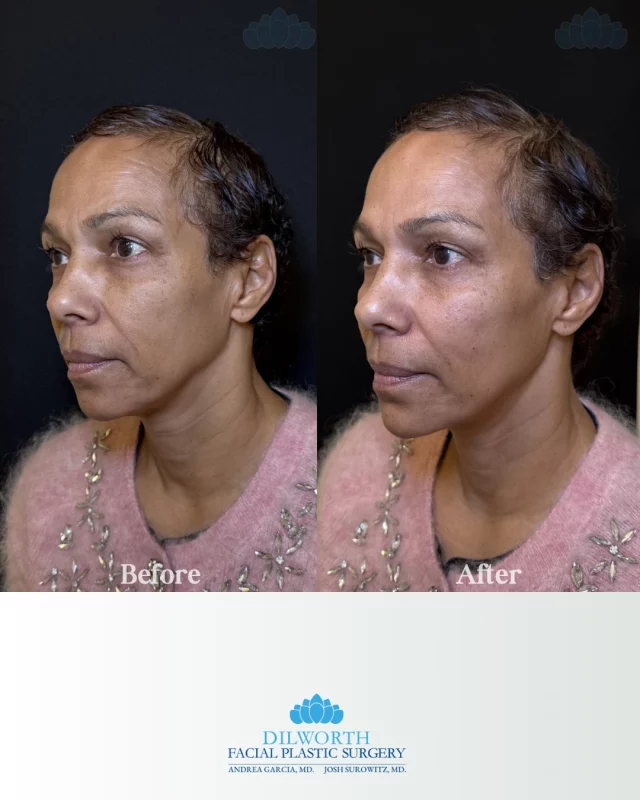 ✨ Facial balancing, not overfilling.
This before + after shows how strategic cheek and chin filler can restore harmony, enhance natural structure, and subtly lift the lower face without changing who you are. The goal is balance, proportion, and a refreshed profile that still looks like you, just more sculpted and confident.

📍 Performed by our Nurse Practitioner, Morgan, who takes a conservative, anatomy-first approach to deliver beautifully natural results.

👉 CTA: Ready for a personalized facial balancing consultation? Call us to start your treatment plan today.

facial balancing filler, chin filler before and after, cheek filler results, natural dermal filler, facial contouring, jawline and chin filler, non surgical facial balancing, filler results charlotte nc, aesthetic injector charlotte, subtle filler results, profile balancing, facial harmony, injectable fillers before after