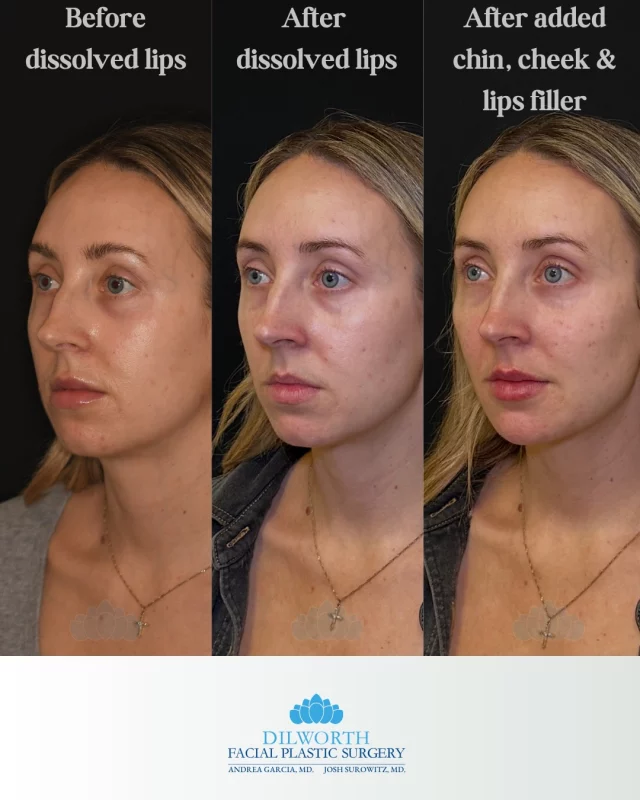 Facial balancing, but make it subtle ✨
Dissolved → refined → enhanced with chin, cheek + lip filler for harmony that still looks like you.

Ready to feel more confident in your features? Book your consultation with our expert injectors at Dilworth Facial Plastics 🤍

facial balancing, chin filler, cheek filler, lip filler, natural filler results, subtle lip filler, dermal filler before and after, non surgical facial contouring, facial harmony, chin projection filler, cheek contour filler, jawline definition, aesthetic injectables, cosmetic dermatology, med spa treatments, natural beauty enhancements, refined facial structure, Charlotte NC med spa, Dilworth Facial Plastics, expert injectors Charlotte