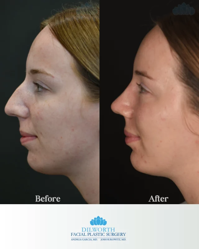 Subtle changes, powerful confidence ✨

This patient’s transformation included a customized rhinoplasty and chin implant to create better facial balance and harmony. The result? A smoother profile, enhanced proportions, and natural-looking definition.

At Dilworth Facial Plastic Surgery, every treatment plan is tailored to YOU—because balance is everything.

📍Charlotte, NC
💬 Thinking about refining your profile? Schedule your consultation today or DM us to learn more.

rhinoplasty Charlotte NC, nose job Charlotte NC, chin implant Charlotte NC, chin augmentation Charlotte, facial balancing procedures, profile balancing surgery, plastic surgery Charlotte NC, facial plastic surgeon Charlotte, natural rhinoplasty results, before and after nose job, chin implant before and after, cosmetic surgery Charlotte NC, nose reshaping surgery, chin enhancement, facial harmony treatment, Dilworth Facial Plastic Surgery