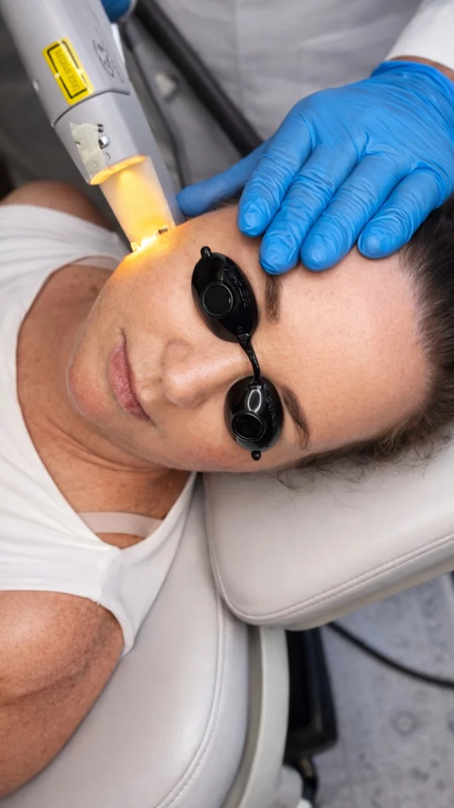 If your skin looks red, flushed, or uneven—this is the treatment we use 👇

Nd:YAG laser is designed to target vascular concerns, helping reduce:
• visible blood vessels
• rosacea + facial redness
• spider veins
• cherry angiomas

By focusing on the source of redness, this treatment helps create a more even, balanced complexion over time.

✨ Quick treatment, minimal downtime, real results.

Ready to calm your skin and reduce redness? Book your consultation with us to see if Nd:YAG is right for you.

Nd:YAG laser, ND YAG laser treatment, rosacea treatment Charlotte NC, redness treatment face, vascular laser treatment, broken capillaries treatment, visible blood vessels face, spider veins treatment face, cherry angioma removal, laser for redness, facial redness treatment, med spa Charlotte NC, aesthetic treatments Charlotte, skin treatments for redness, non invasive laser treatment, even skin tone treatment, Dilworth Facial Plastics